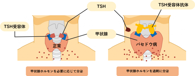 は バセドウ 病 と 甲状腺の病気｜バセドウ病｜橋本病｜症状